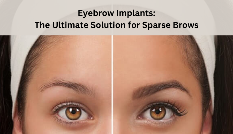 Eyebrow Implants: The Ultimate Solution for Sparse Brows