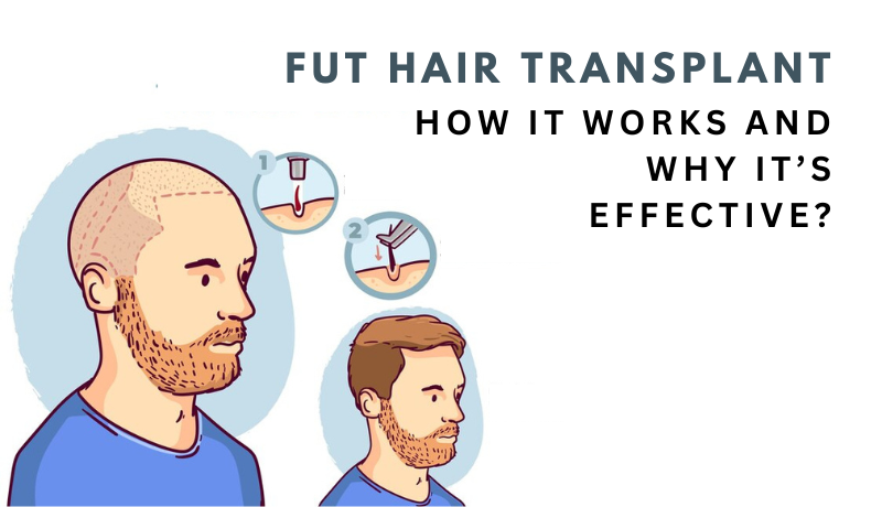 fut hair transplant